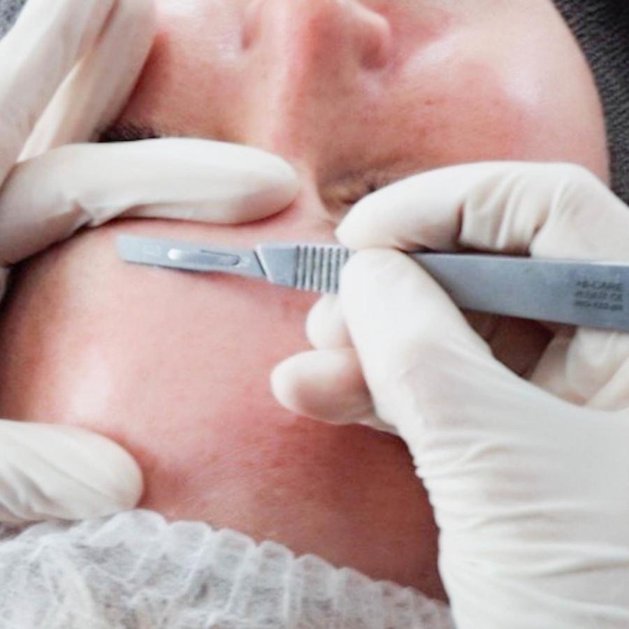 dermaplaning